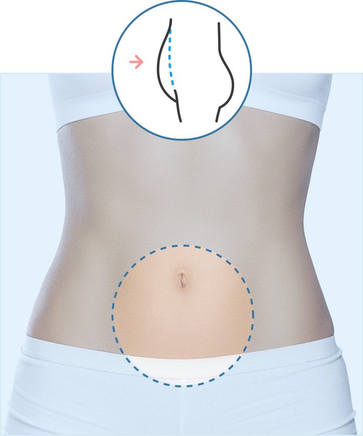 operacion-abdominoplastia