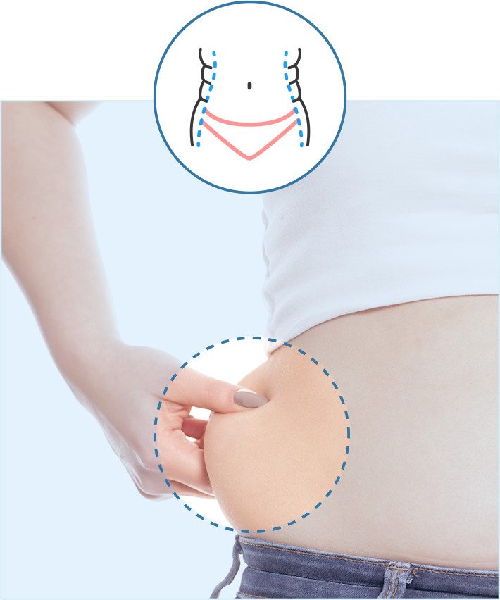 cirugia-obesidad-morbida-bariatrica