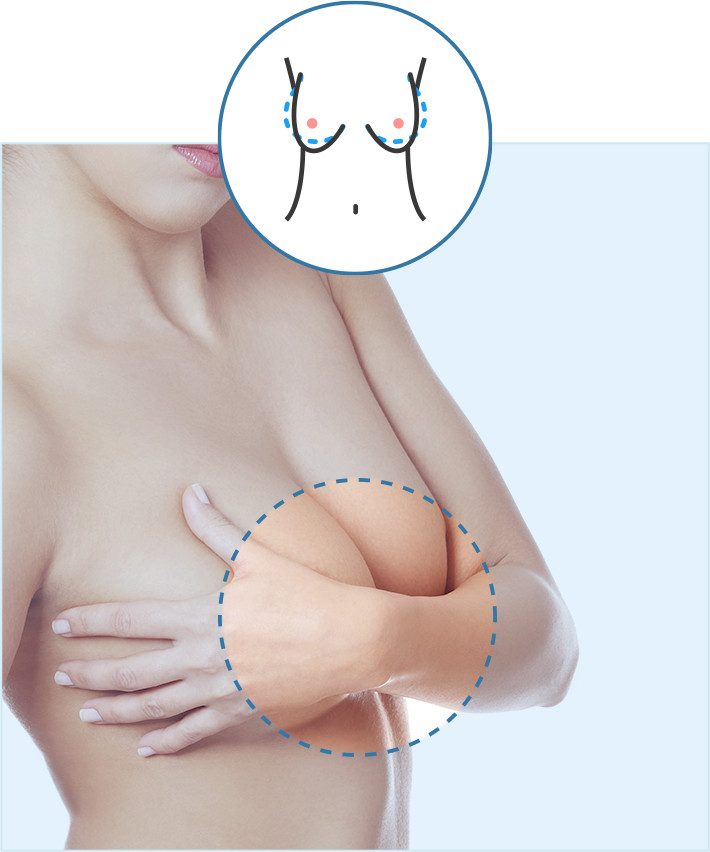 Operación de mamas tuberosas