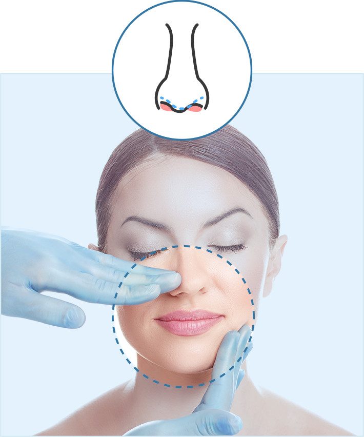 cirugia-tabique-nasal